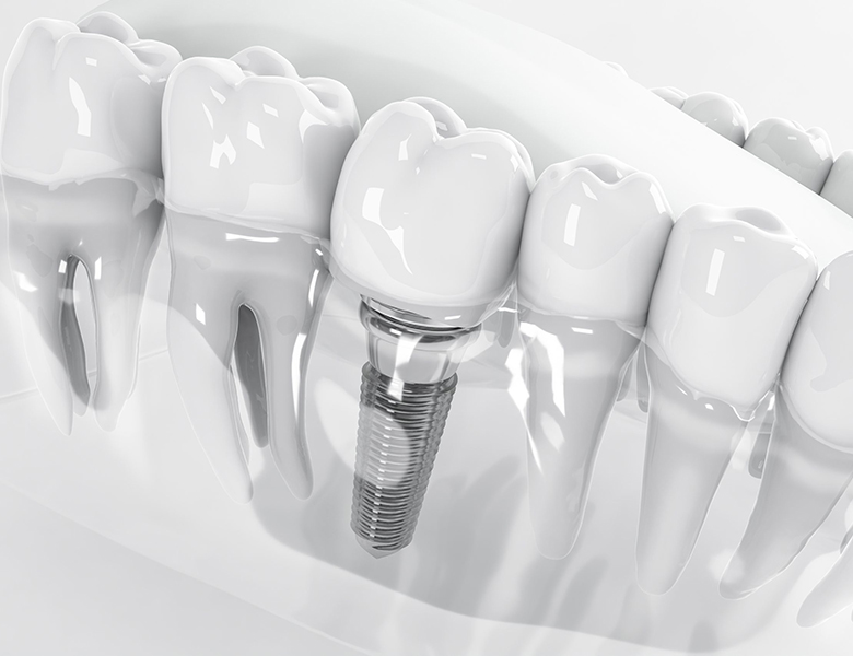 仙台市青葉区台原の歯医者、台原みなも歯科クリニックのインプラント治療