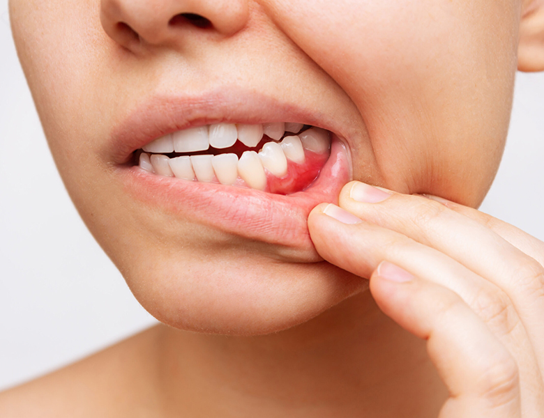 仙台市青葉区台原の歯医者、台原みなも歯科クリニックはの歯周病治療