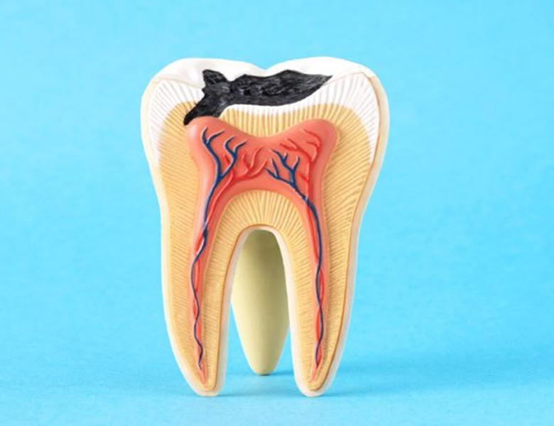 仙台市青葉区台原の歯医者、台原みなも歯科クリニックのむし歯治療