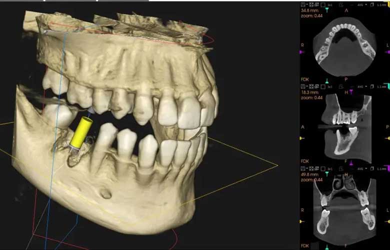 仙台市青葉区台原の歯医者、台原みなも歯科クリニックの歯科用CTによる精密診断