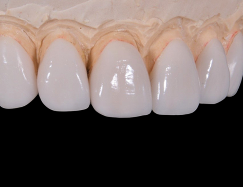 仙台市青葉区台原の歯医者、台原みなも歯科クリニックの審美歯科治療