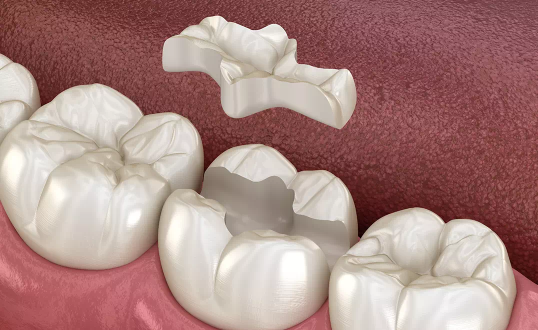 仙台市青葉区台原の歯医者、台原みなも歯科クリニックのむし歯治療