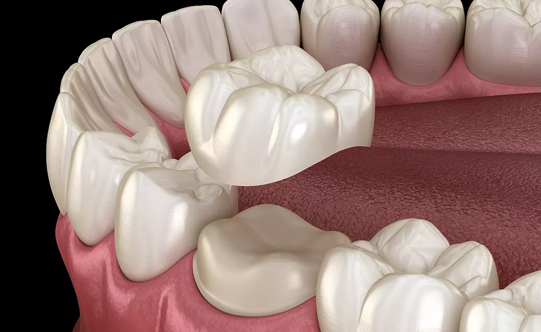 仙台市青葉区台原の歯医者、台原みなも歯科クリニックのむし歯治療