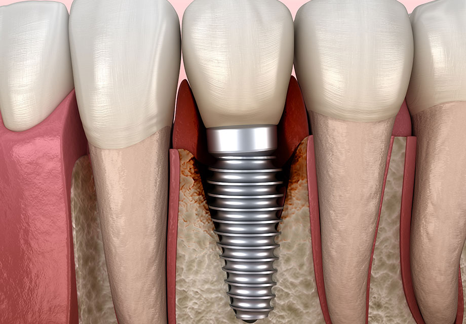 仙台市青葉区台原の歯医者、台原みなも歯科クリニックのインプラント治療