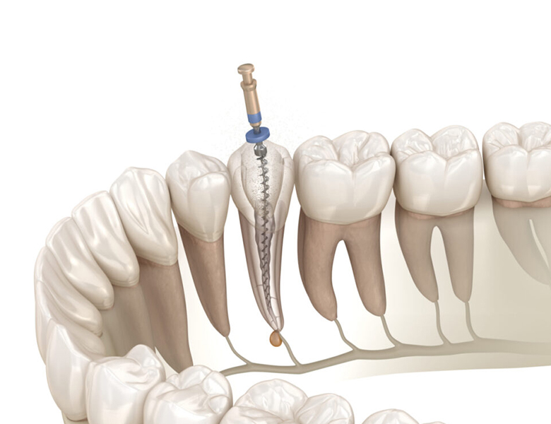 仙台市青葉区台原の歯医者、台原みなも歯科クリニックの根管治療