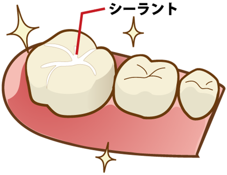 仙台市青葉区台原の歯医者、台原みなも歯科クリニックの小児歯科治療